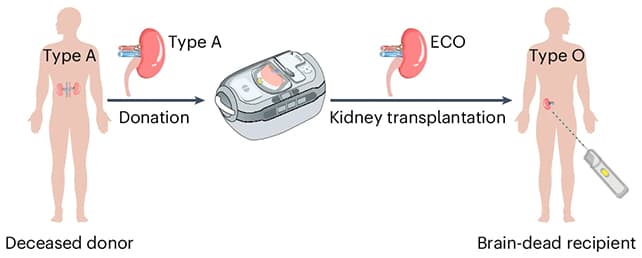 The 'Universal Kidney' Lie: Who Really Profits When Blood Barriers Crumble? - Image 4