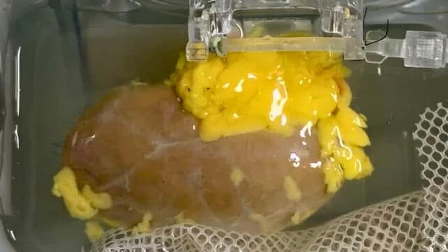 The 'Universal Kidney' Lie: Who Really Profits When Blood Barriers Crumble? - Image 1